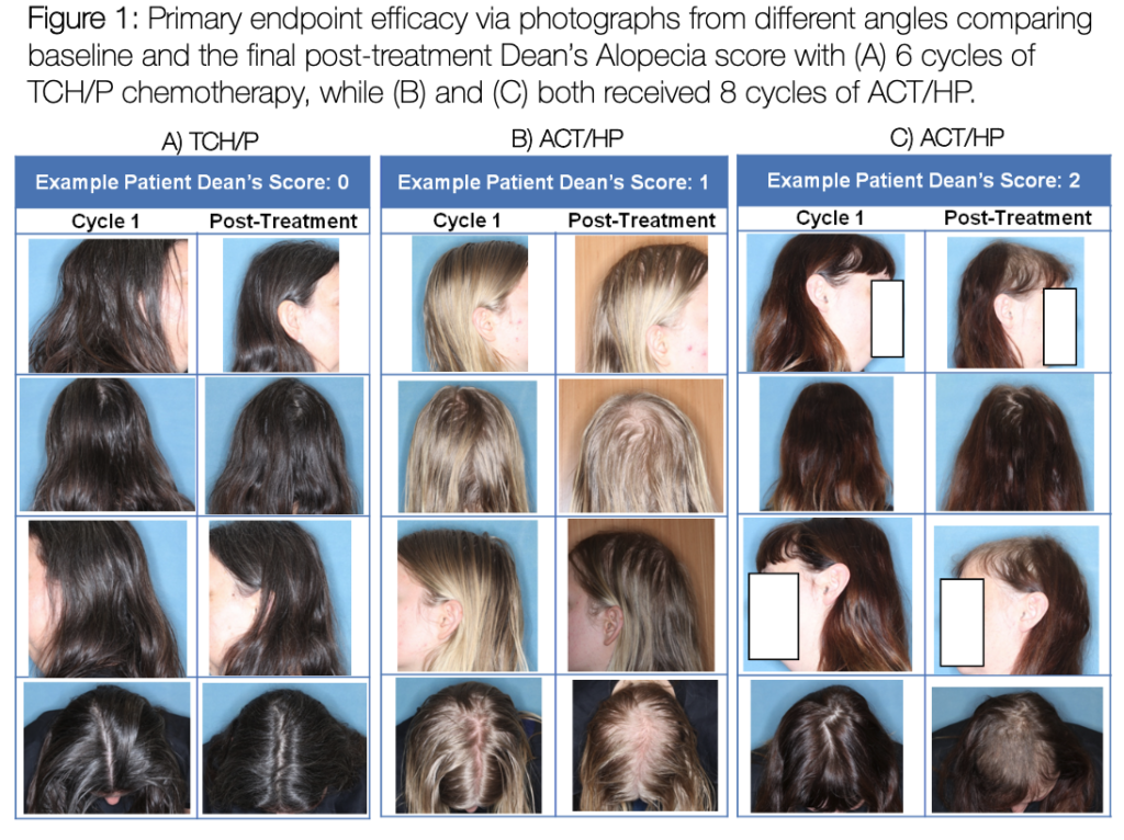 Photographic comparison of the efficacy of capillary cooling in chemotherapy patients, evaluating the alopecia score after different treatment cycles.